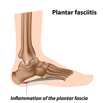Plantar Fasciitis - THE FOOT FIXERS
