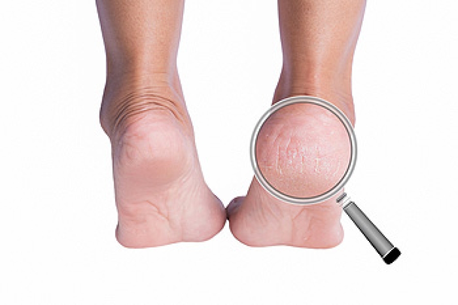 10 Natural Remedies For Cracked Heels – Morpheme Remedies | India